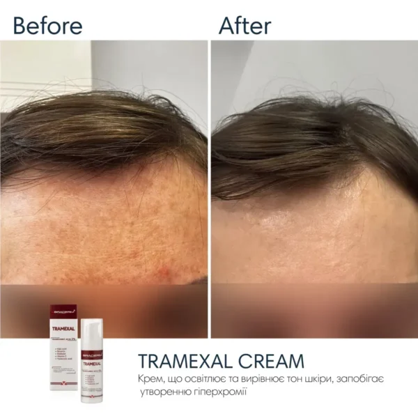 braderm-tramexal-cream-info